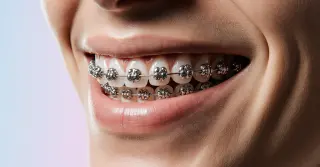 Aparelho Ortodôntico