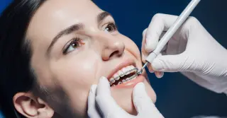 Colocar Aparelho nos Dentes