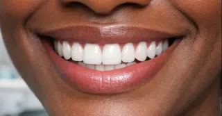 Fechar Diastema com Resina