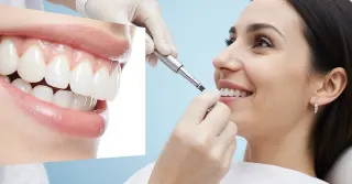 Prótese sobre Implante