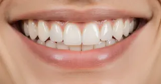 Restaurações Estéticas em Resina